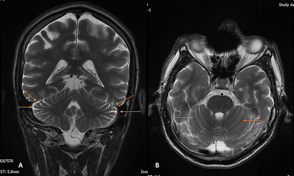 T2-weighted-brain-MRI-in-coronal-view-(A)-and-axial-view-(B)-showing-(arrows)-a-slight-accentuation-of-cerebellar-folia-in-the-context-of-a-patient-with-Capgras-syndrome.