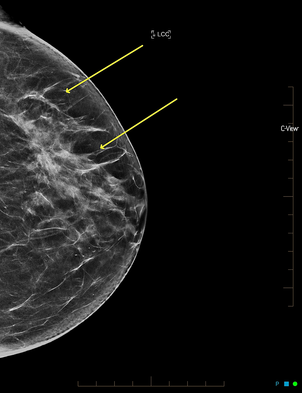 Cureus | Large Non-enhancing Breast Cancer on Breast Magnetic Resonance ...