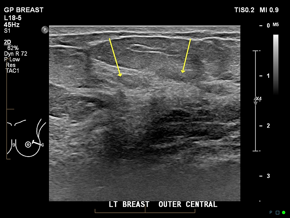 Cureus Large Nonenhancing Breast Cancer on Breast Resonance