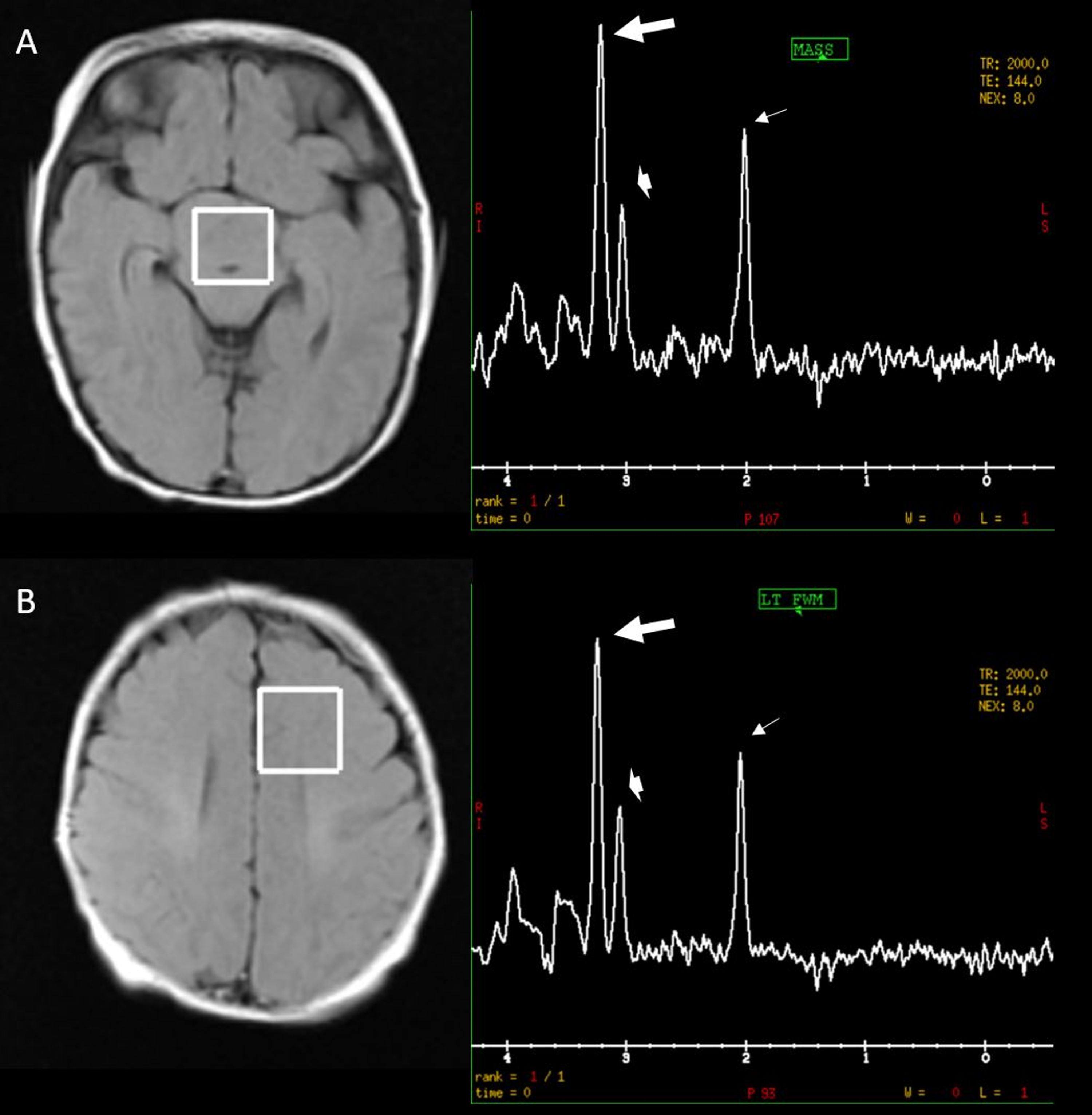 Cureus Presumptive Diagnosis of PallisterHall Syndrome Using