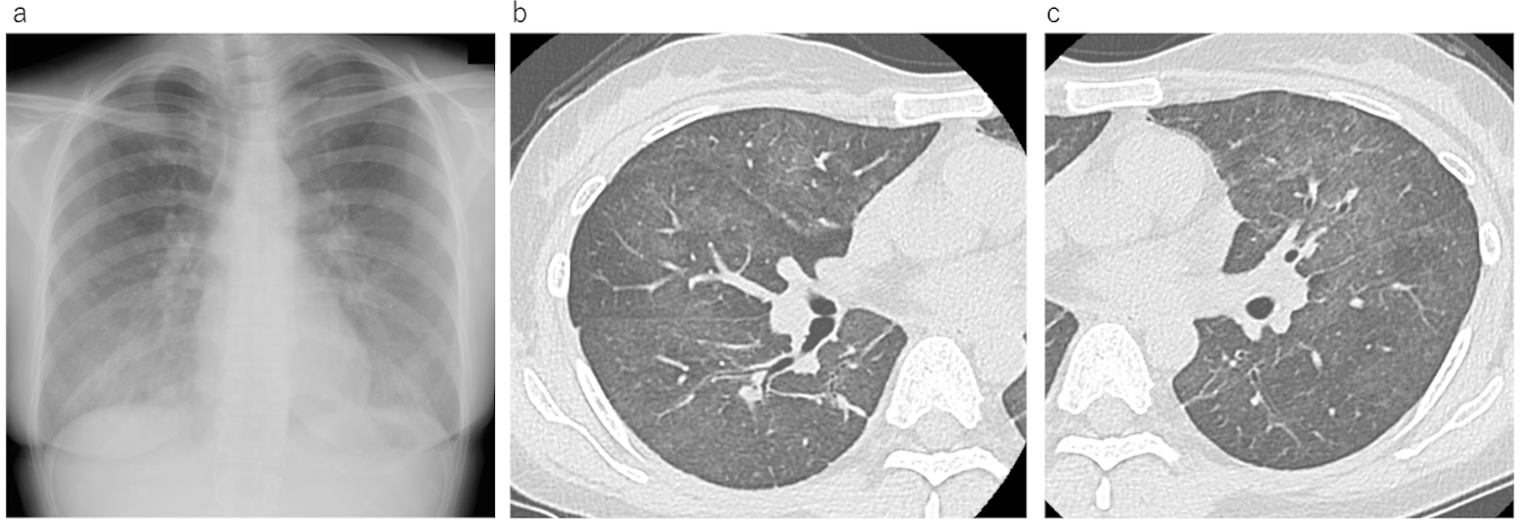 Pneumocystis jirovecii Pneumonia in Three Patients With Breast Cancer ...