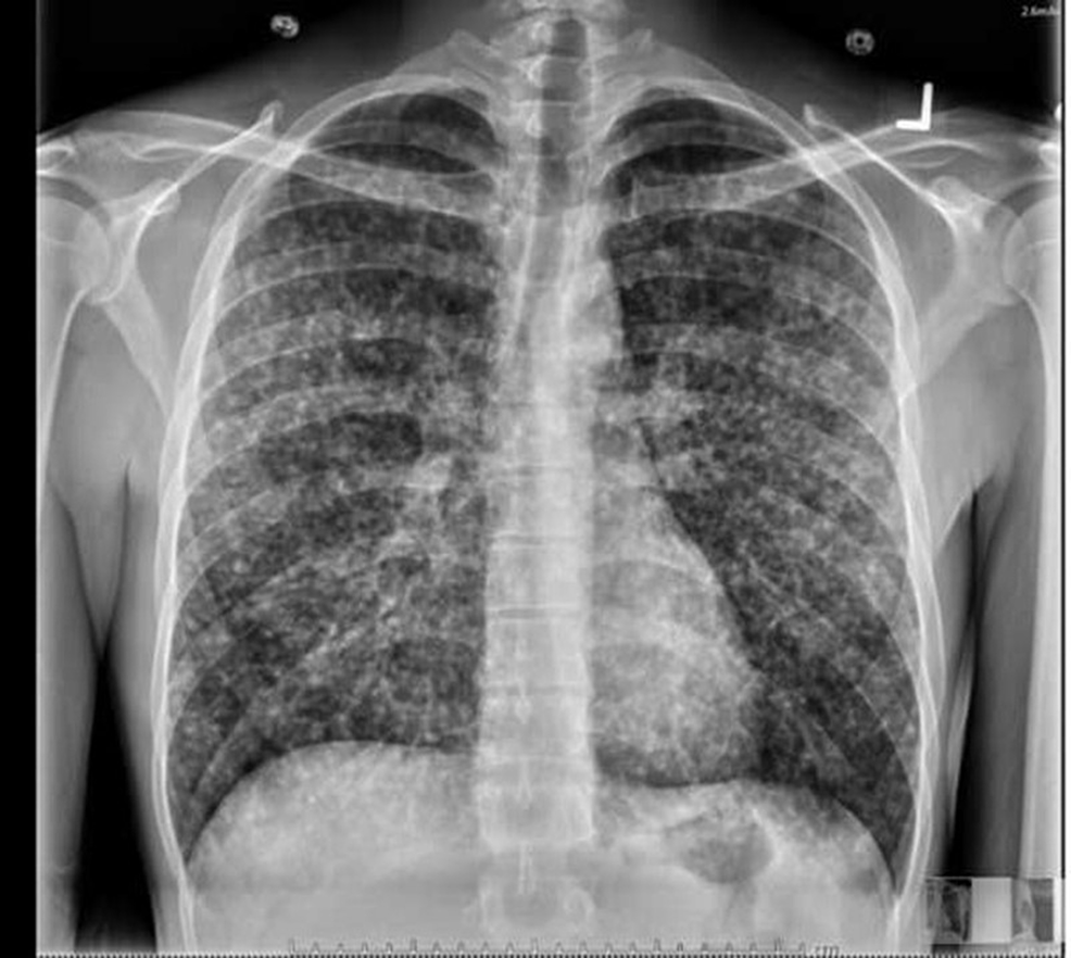 Posterior-anterior-chest-x-ray-on-admission