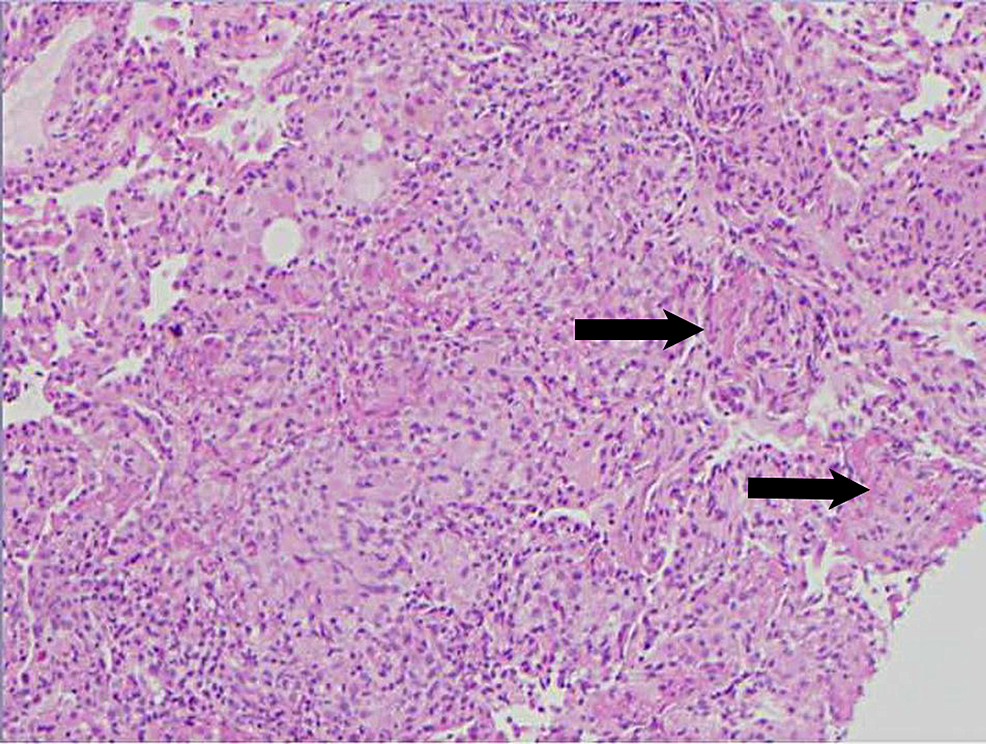 Transbronchial-biopsy-pathology-slide-at-10x-magnification.-The-black-arrows-represent-non-caseating-granulomas.