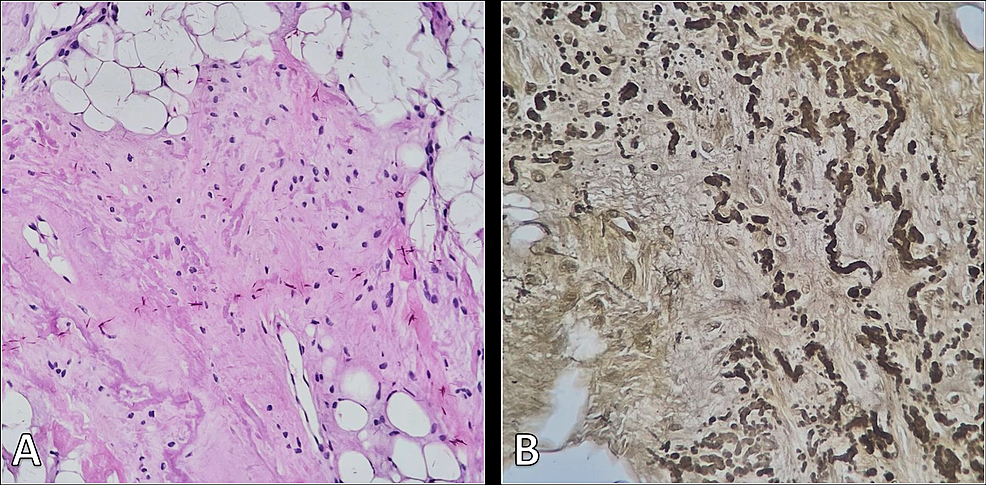 Cureus | Bilateral Elastofibroma Dorsi: A Case From General Practice