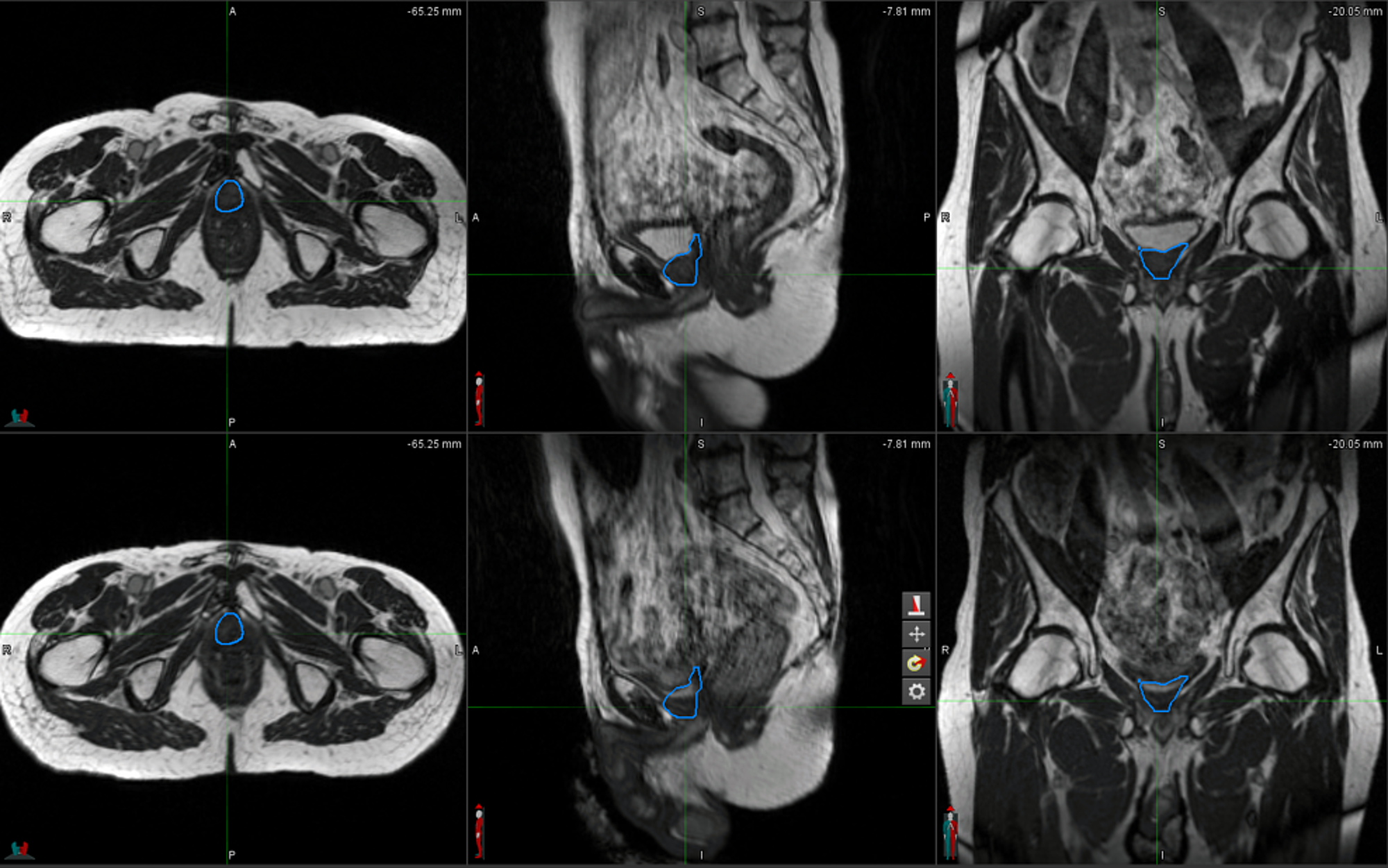 Cureus Mri Guided Dose Escalated Salvage Radiotherapy For Bulky Bladder Neck Recurrence Of 0790