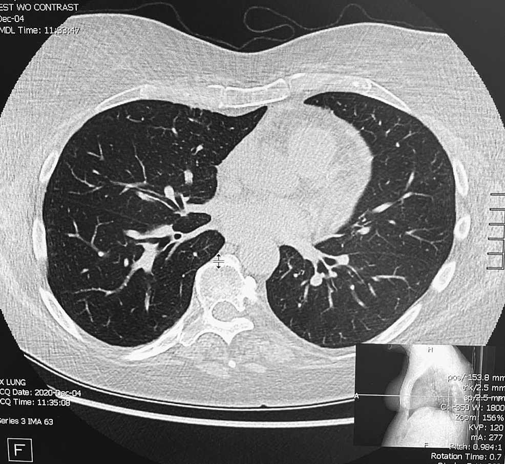 CT-image-of-pulmonary-post-infectious-changes.-The-presence-of-lymphadenopathy-and-calcified-nodules-is-also-noted