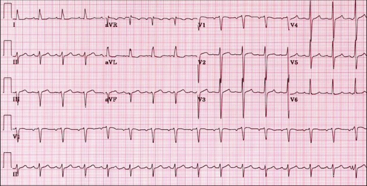 The Electrocardiogram Ecg For Cardiac Diagnosis - vrogue.co