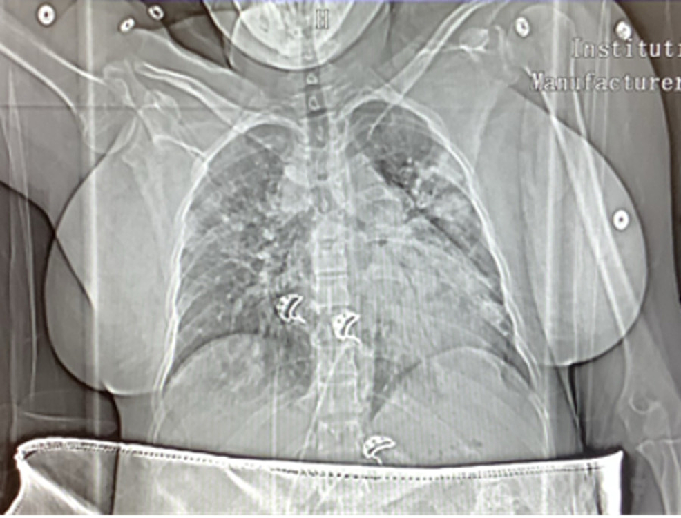 CT-angiogram-chest-showing-no-evidence-of-pulmonary-emboli-and-extensive-patchy-multifocal-pneumonia-consistent-with-COVID-19-pneumonia.