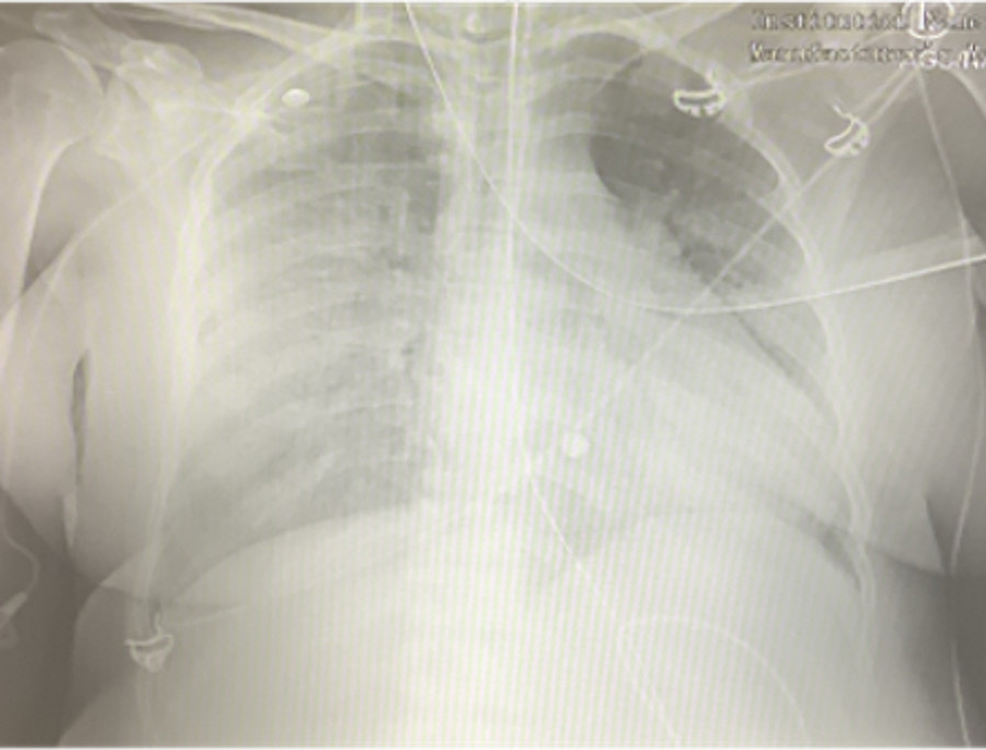 Chest-X-ray-showing-hazy-infiltrates-with-airspace-disease-throughout-the-right-lung-as-well-as-in-the-left-middle-and-lower-lung-consistent-with-viral-pneumonia.