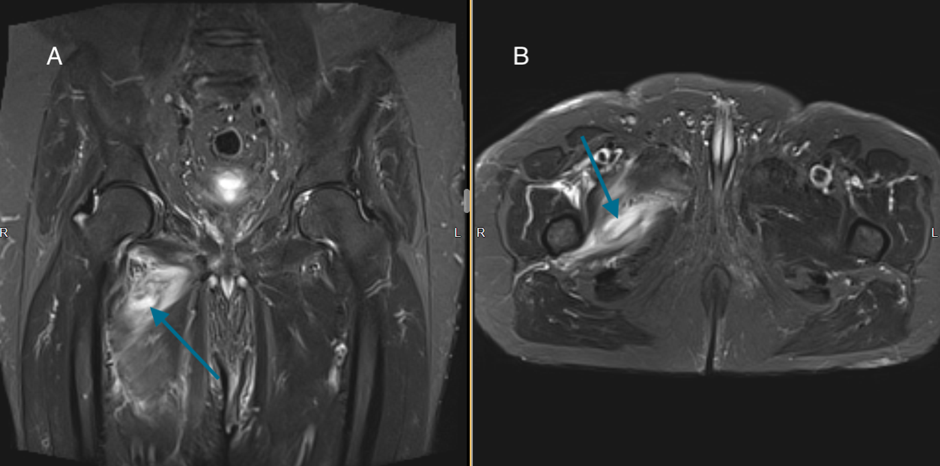 Cureus Hip Adductor Muscle Abscess Descending From Septic Symphysitis