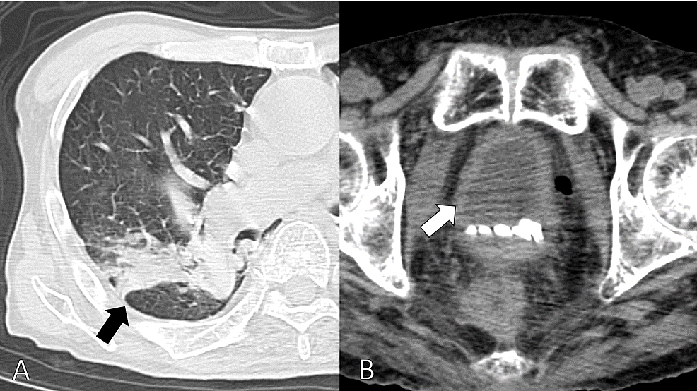 CT-scan-from-the-neck-to-the-pelvis-showing-infiltration-of-the-right-lung-(A).-And-no-high-density-areas-in-the-bladder-indicative-of-hemorrhage-(B).
