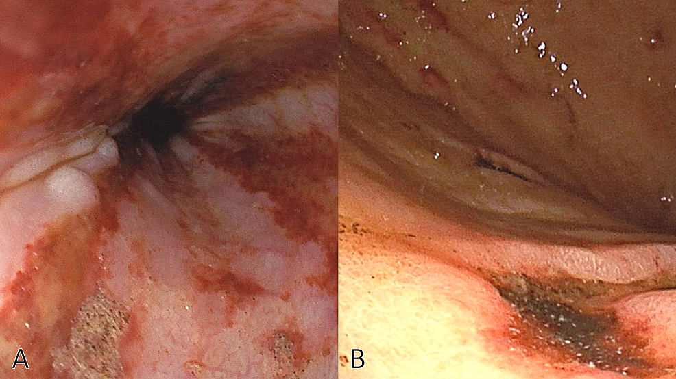 Upper-gastrointestinal-endoscopy-revealing-multiple-esophageal-ulcers-(A)-and-multiple-gastric-ulcers-(B).