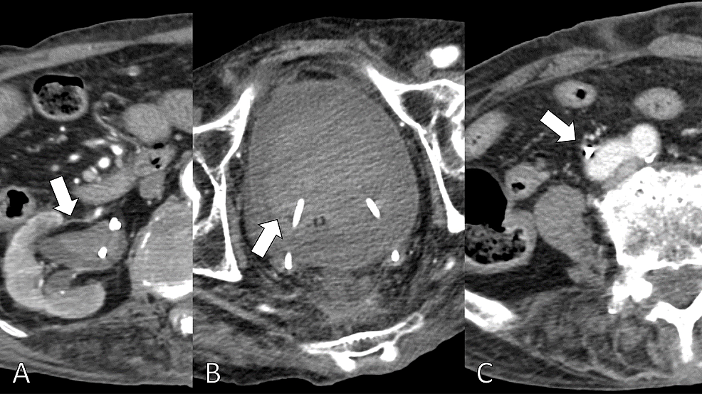 Contrast-enhanced-CT-revealing-the-higher-density-area-in-the-right-renal-pelvis-(A),-higher-density-areas-in-the-urinary-bladder-(B),-and-the-right-common-iliac-arterio-ureteral-fistula-(C).