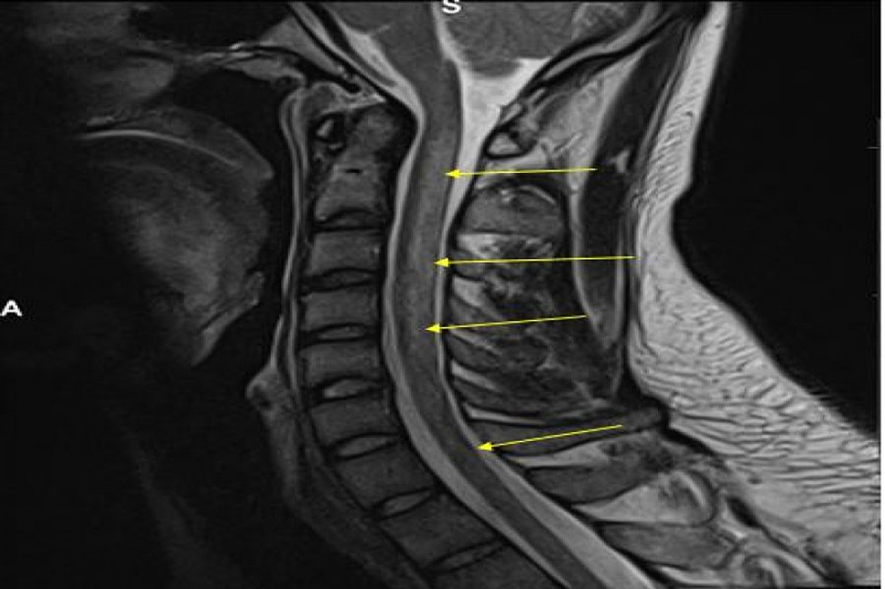 Functional Vitamin B12 Deficiency in Association With Nitrous Oxide ...