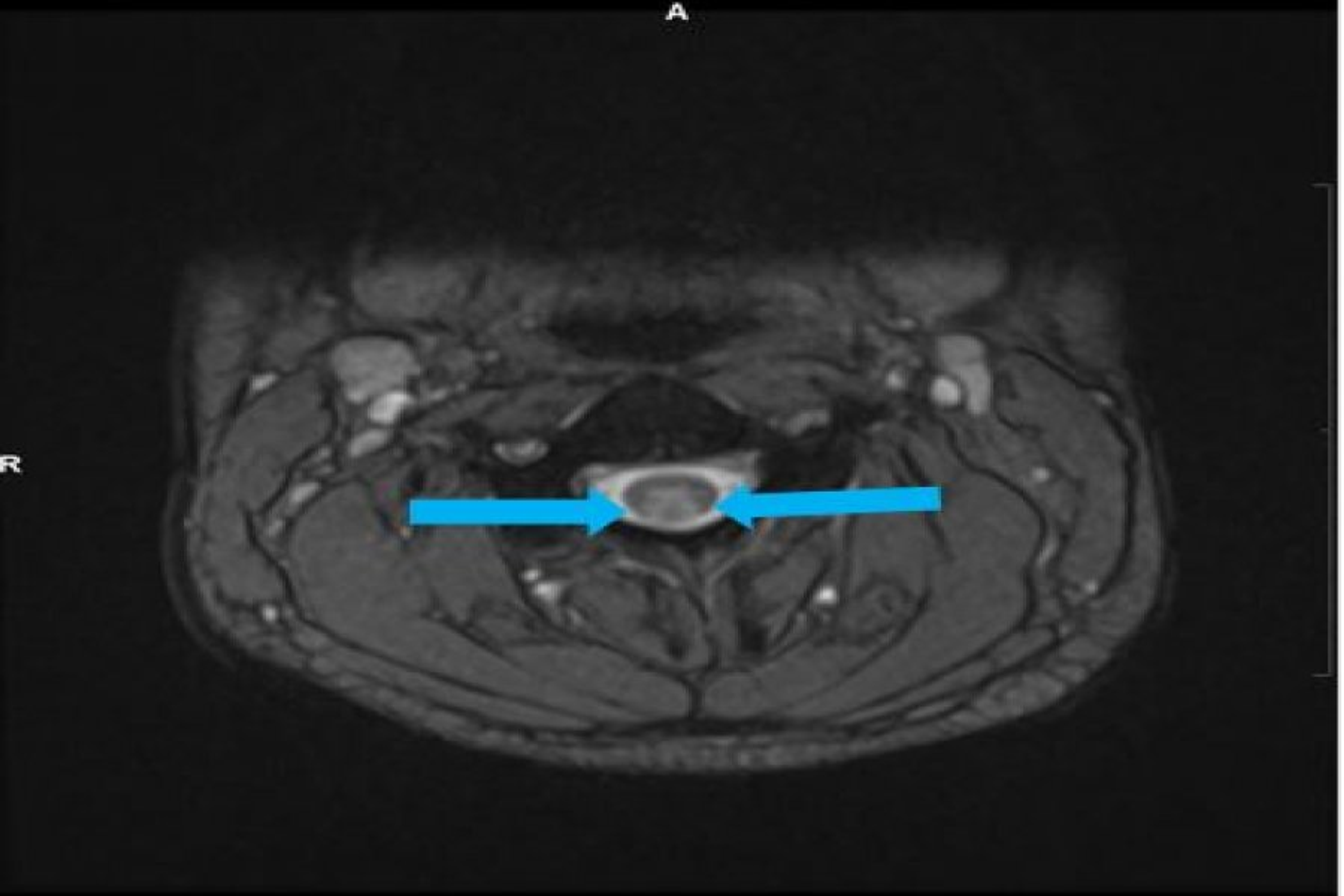 Cureus Functional Vitamin B12 Deficiency in Association With Nitrous
