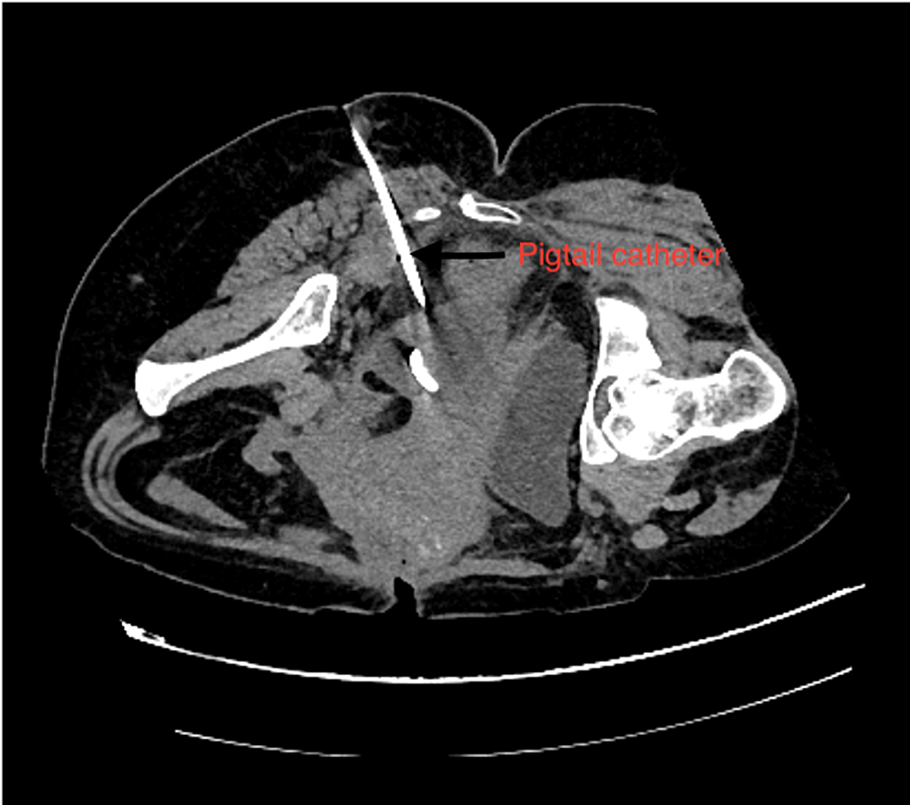 Cureus Post Caesarean Section Deep Pelvic Abscess CT Guided
