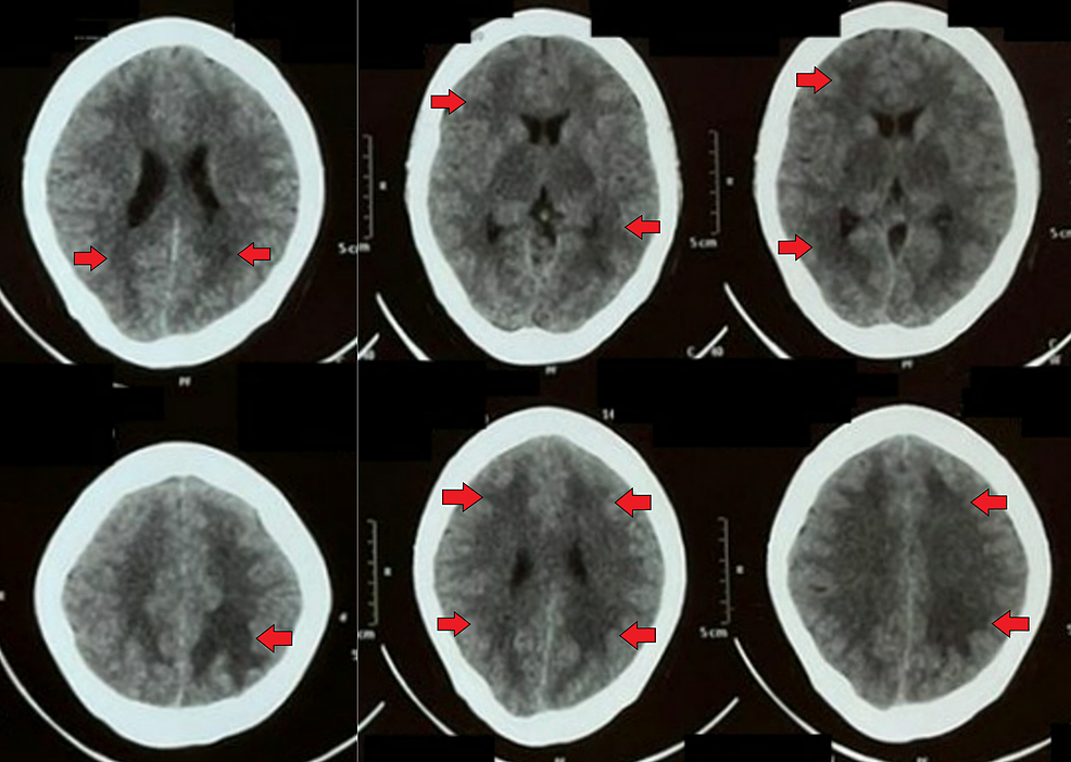 Cureus | Dengue Encephalitis: A Case Series on a Rare Presentation of Dengue  Fever | Article