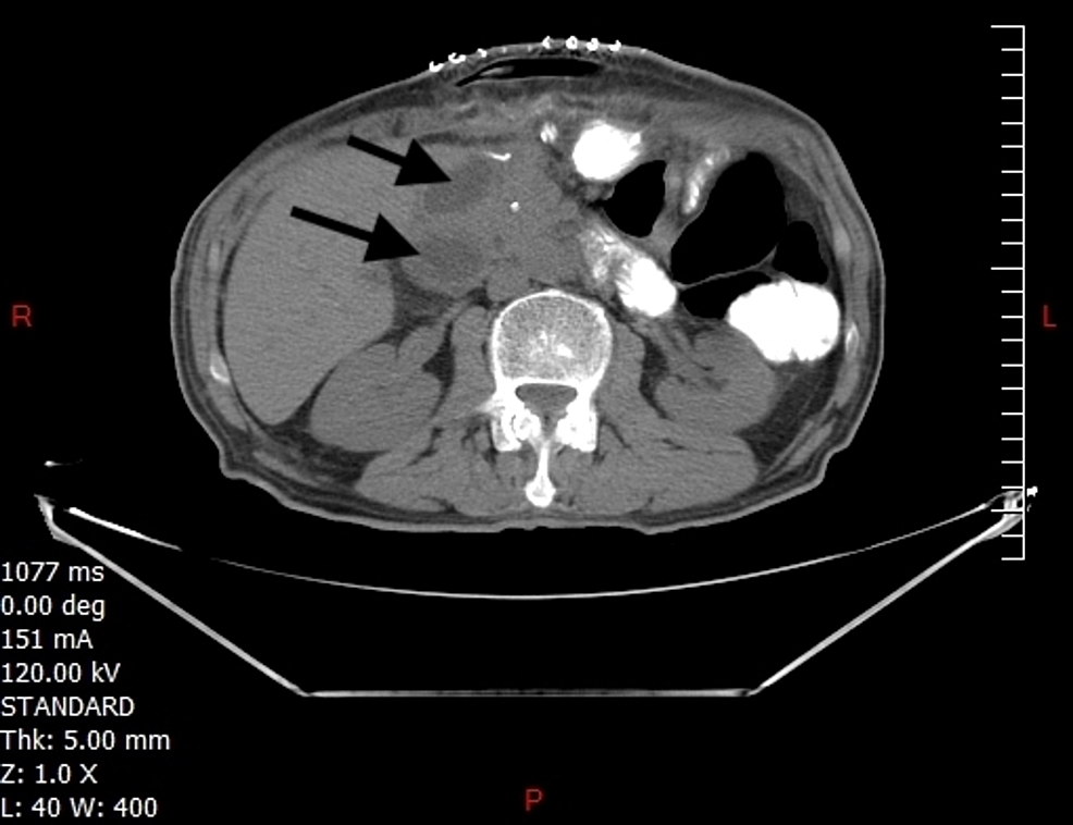 Abdominal-CT-scan-with-oral-contrast-showing-biliary-ducts-dilation-(arrows)