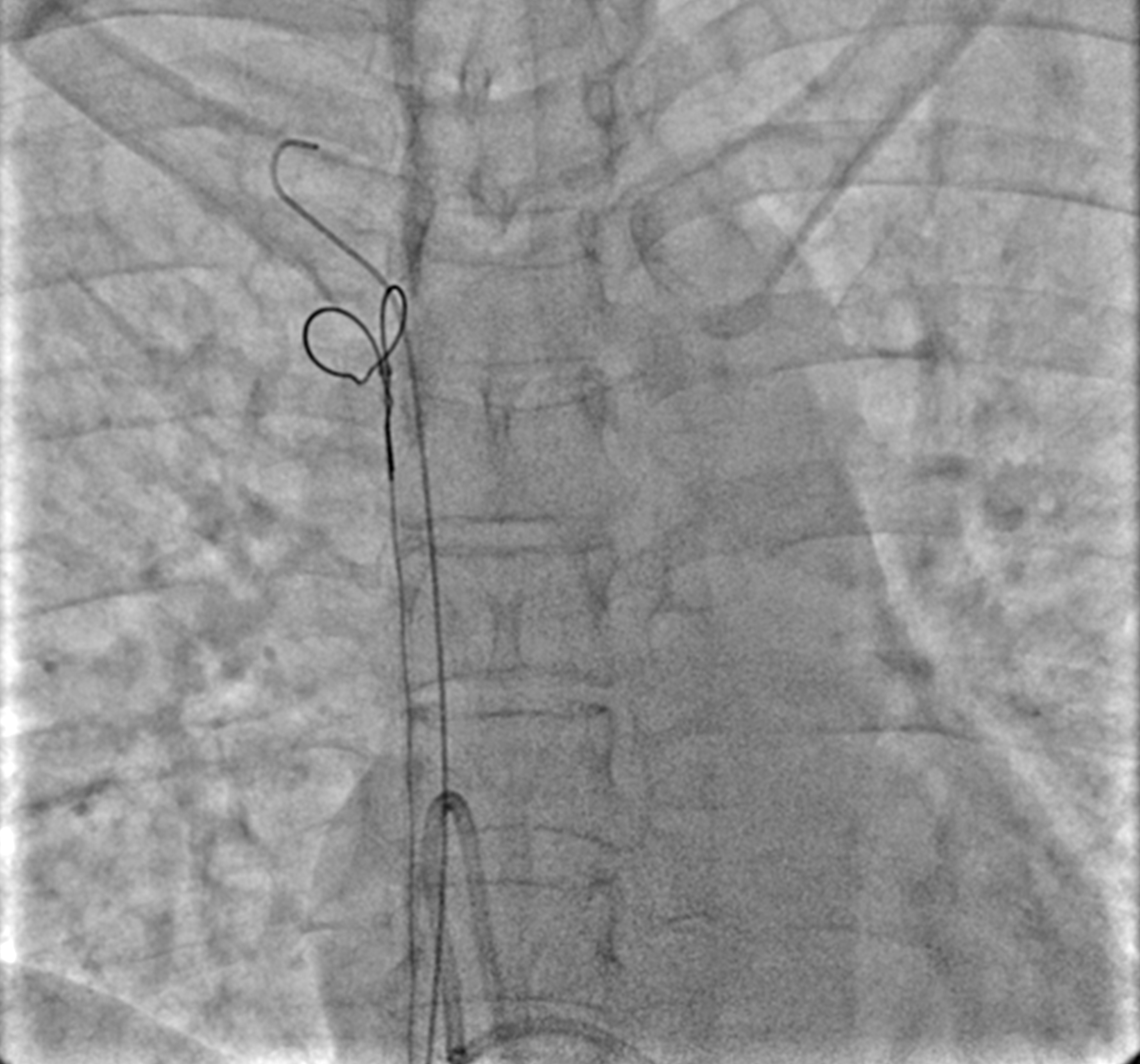 Cureus Percutaneous Retrieval of Dislodged Chemo Port Catheter With