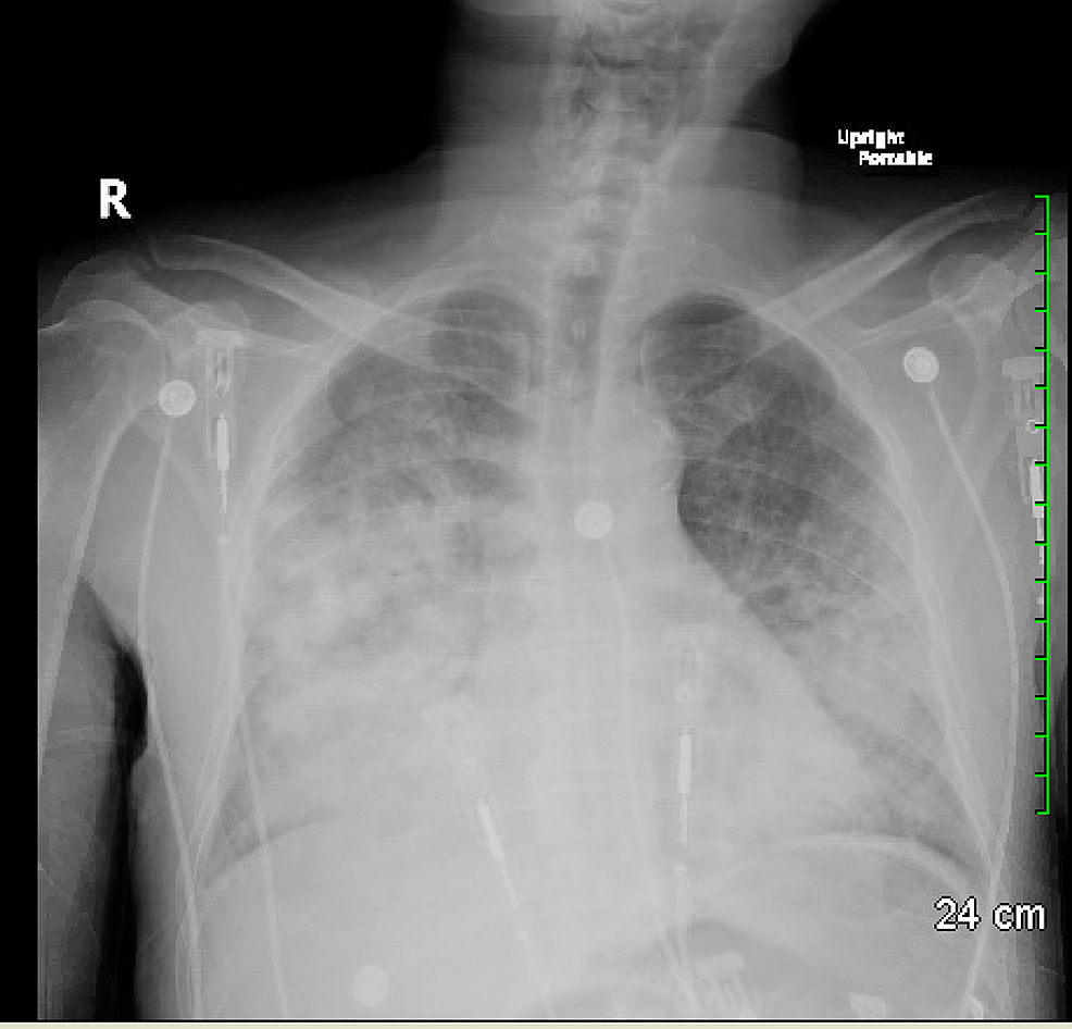 Chest-X-ray-showing-confluent-opacities-in-the-lungs-bilaterally-(right-greater-than-left)