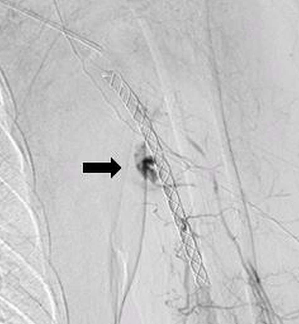 Post-stenting-angiogram-showing-a-few-vascular-channels-(Arrow)-filling-in-the-venous-phase