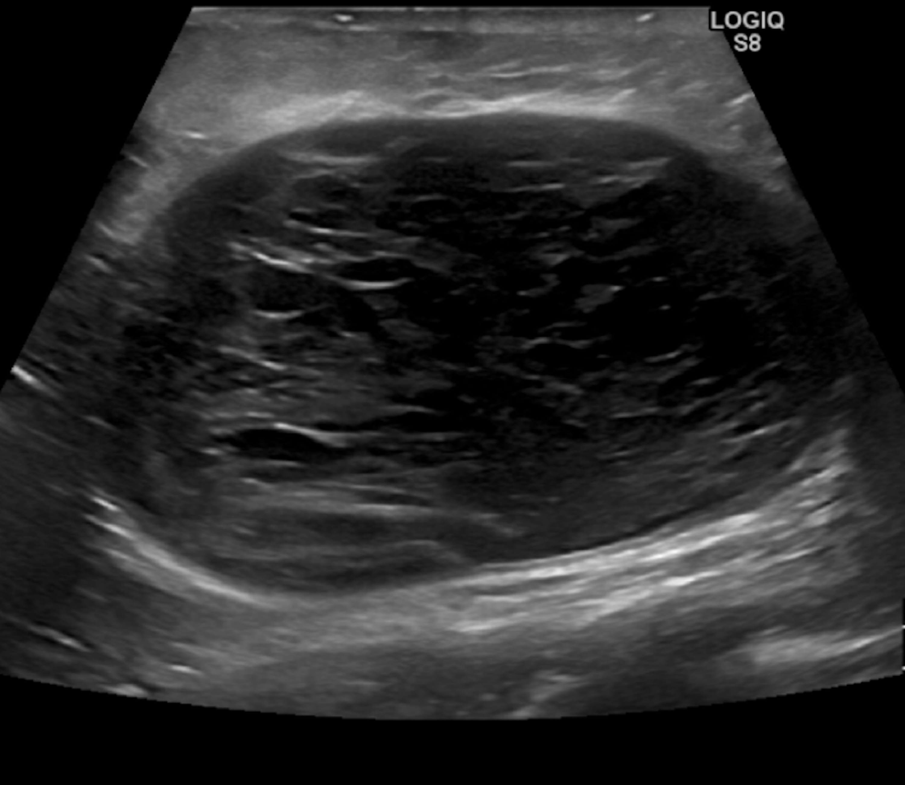 Cureus Capsulectomy Can Successfully Treat Chronic Encapsulated