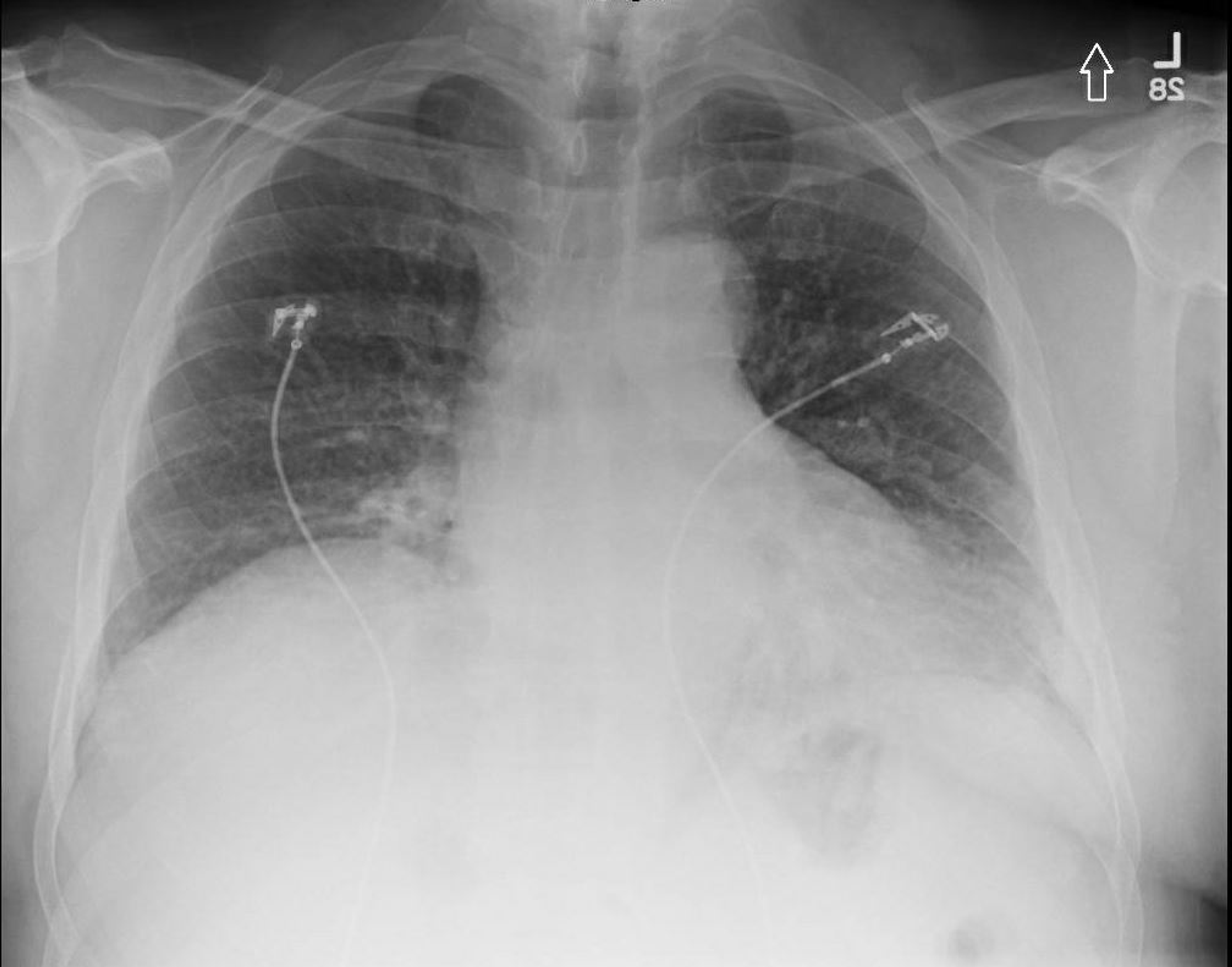 Cureus Hidden Dangers of Severe Obstructive Sleep Apnea