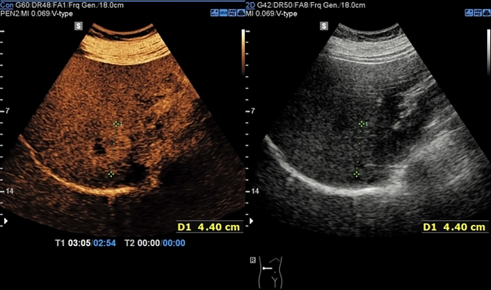 The-liver-lesion-is-barely-seen-on-conventional-B-mode-US-(on-the-right)-compared-to-early-arterial-hyperenhancement-(in-the-early-post-contrast-phase)-seen-with-CEUS-using-IV-SonoVue-(on-the-left).