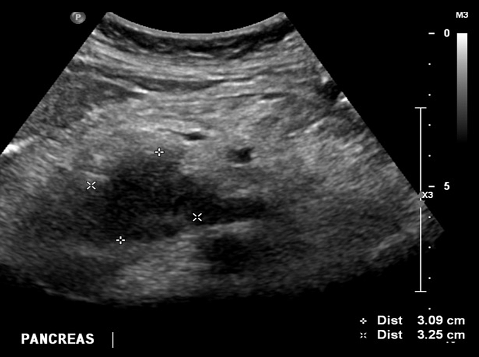 Longitudinal-ultrasound-images-of-the-head/uncinate-process-of-the-pancreas-shows-hypoechogenic-mass-(due-to-decreased-vascularity),-pancreatic-adenocarcinoma-until-proven-otherwise.