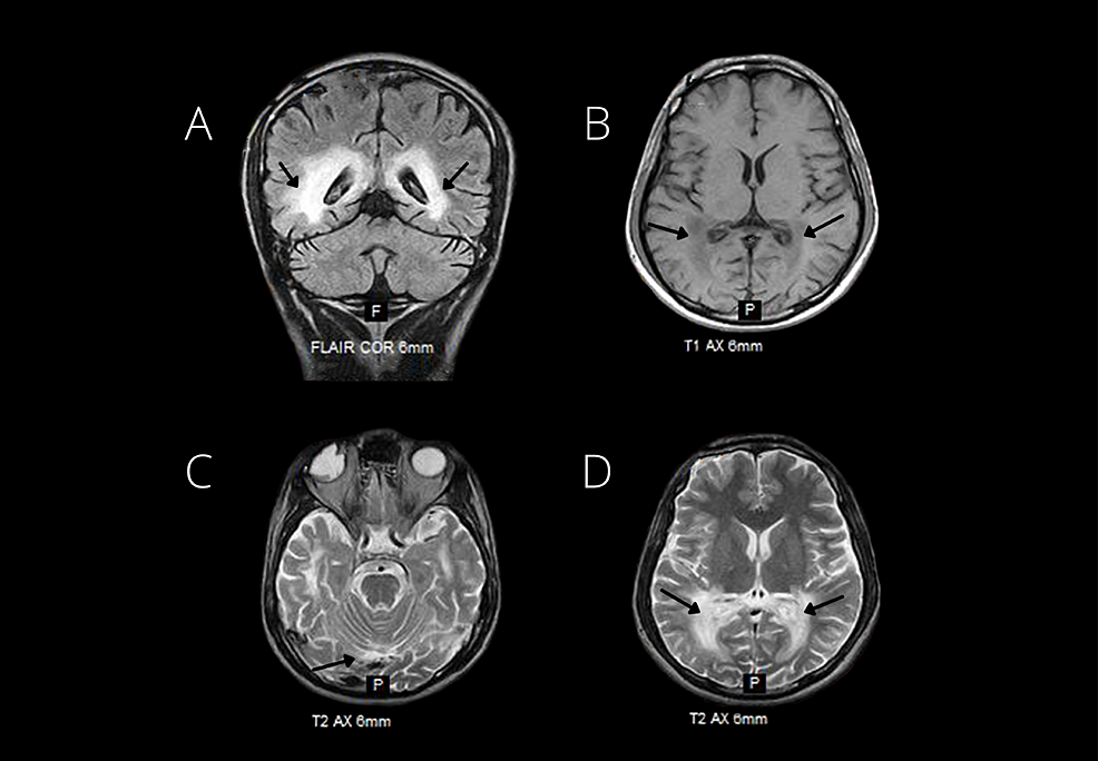 Cureus X Linked Adrenoleukodystrophy In A 20 Year Old Male With An