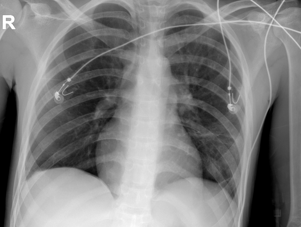 Frontal-chest-radiograph-shows-clear-lung-fields-with-no-infiltrates.