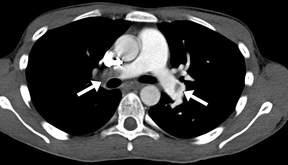 CT-pulmonary-angiography-shows-bilateral-pulmonary-embolism-(arrows).
