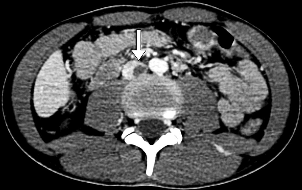 CT-abdominal-angiography-shows-a-filling-defect-(arrow)-in-the-inferior-vena-cava-representing-a-thrombus.