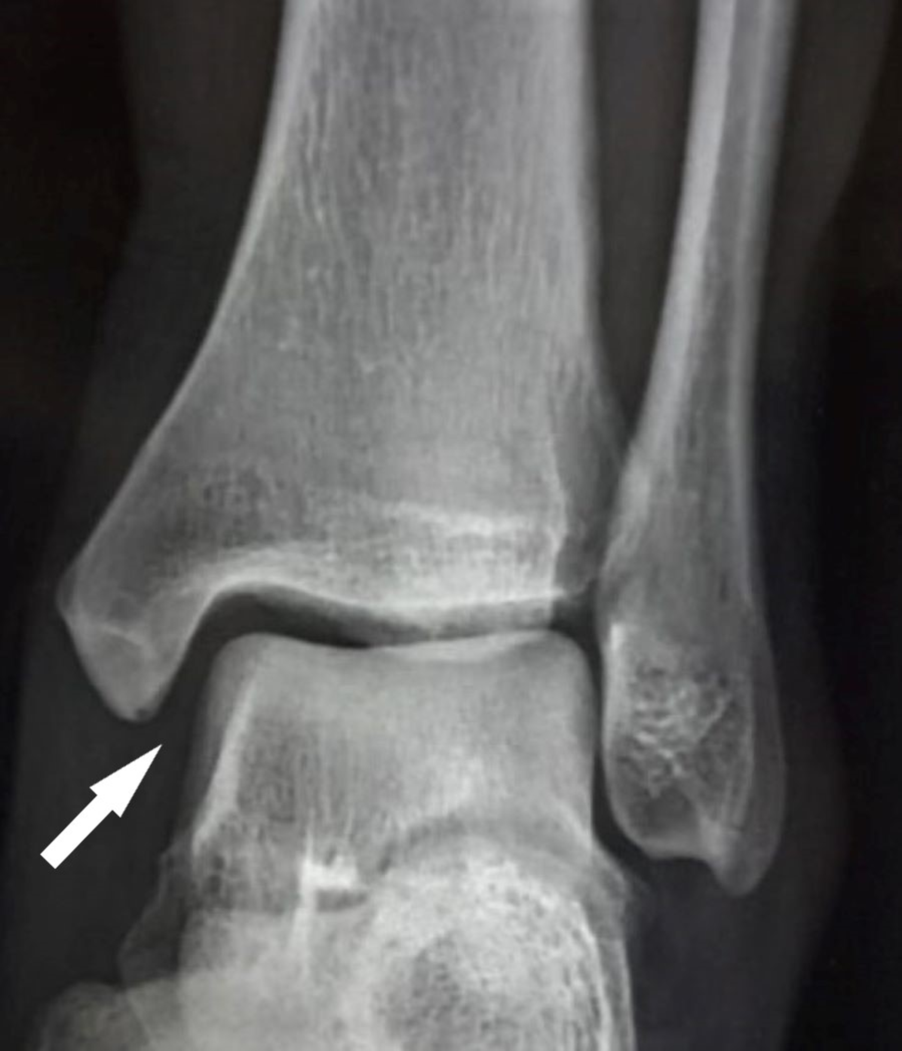 Distal Tibial Fracture Medial And Posterior Malleolar Image | Images ...
