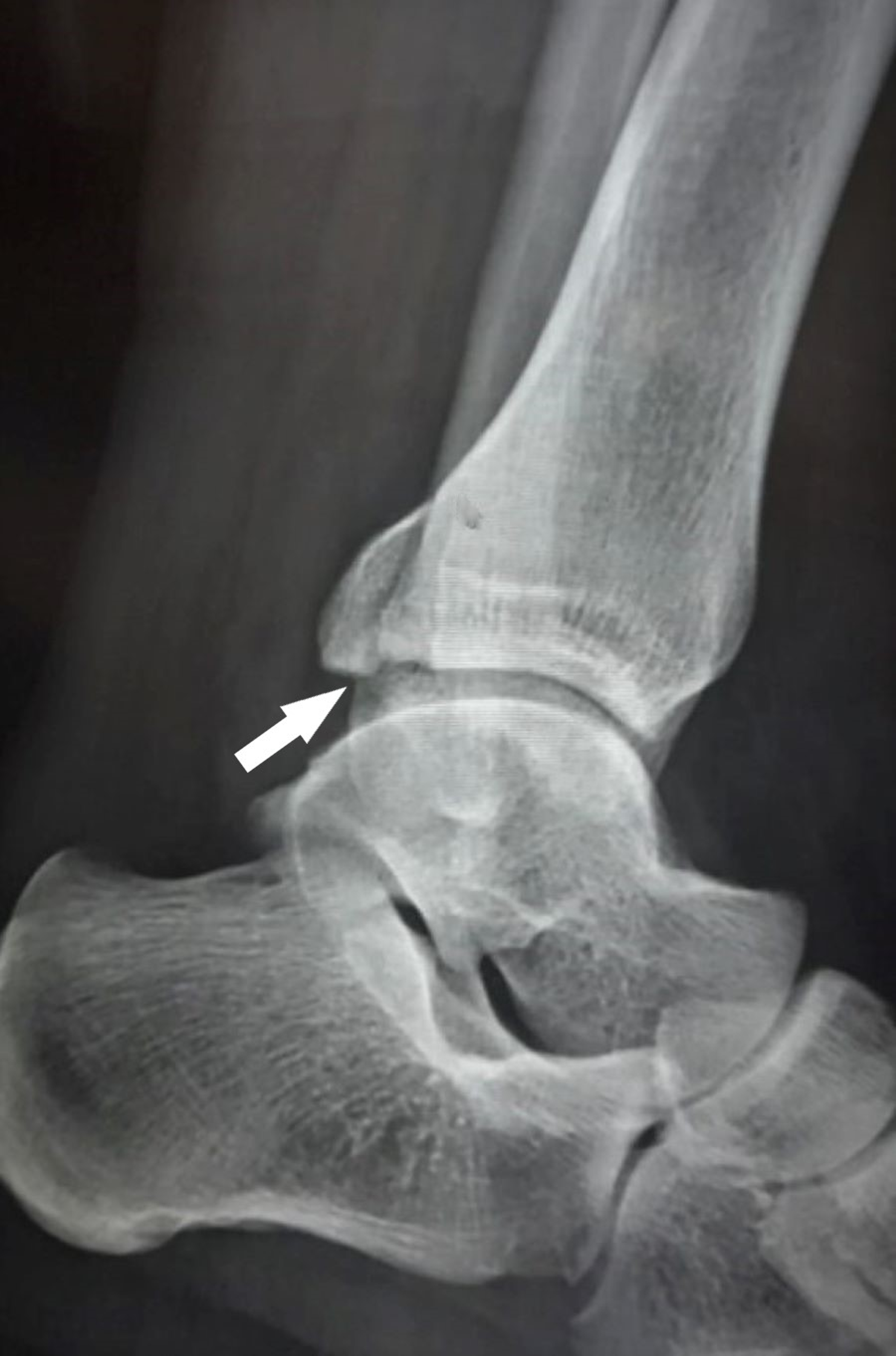 Cureus Isolated Posterior Malleolar Fracture A Case Report of a Rare