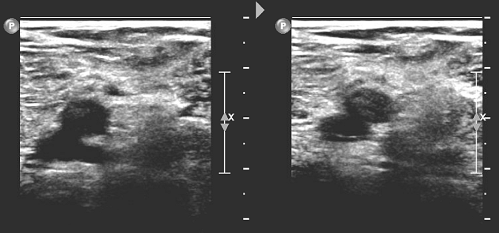 Doppler-venous-ultrasound-of-the-right-lower-extremity-with-one-of-the-trunks-not-compressible-demonstrating-an-acute-deep-vein-thrombosis-in-the-right-trunks.
