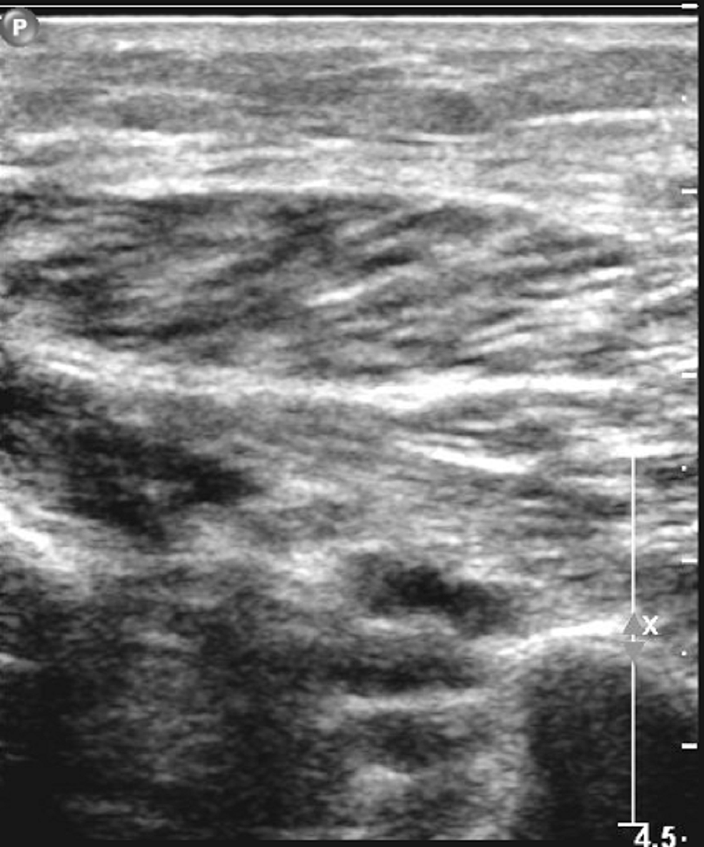 Doppler-venous-study-of-the-right-lower-extremity-with-the-right-peroneal-vein-not-compressible-demonstrating-an-acute-deep-vein-thrombosis-in-the-right-peroneal-vein.
