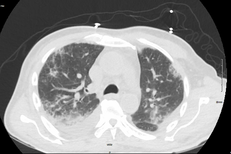 CT-chest-showing-patchy-bilateral-interstitial-and-alveolar-infiltrate-with-small-bilateral-pleural-effusion