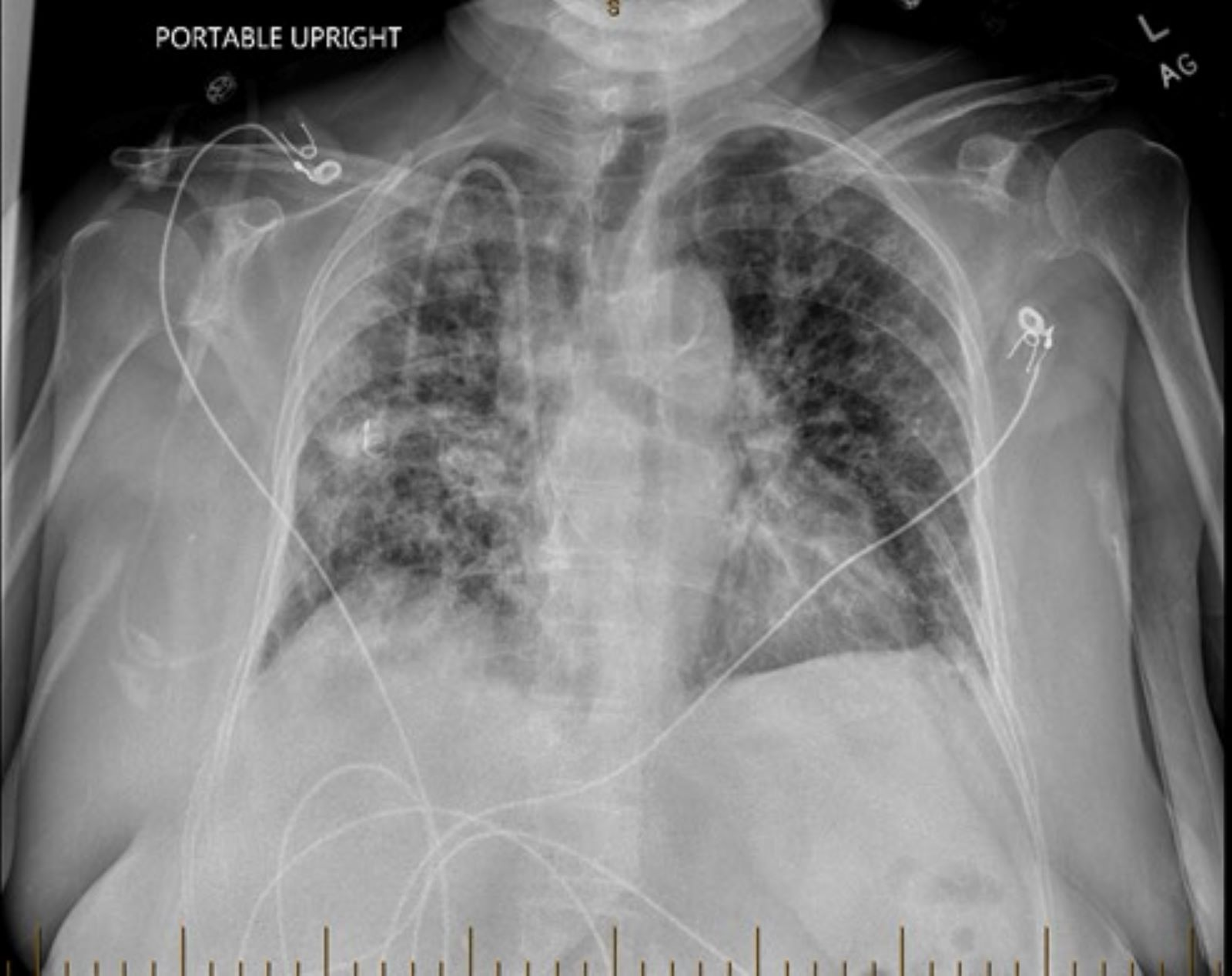 Cureus BleomycinInduced Lung Injury After Intravenous Iron
