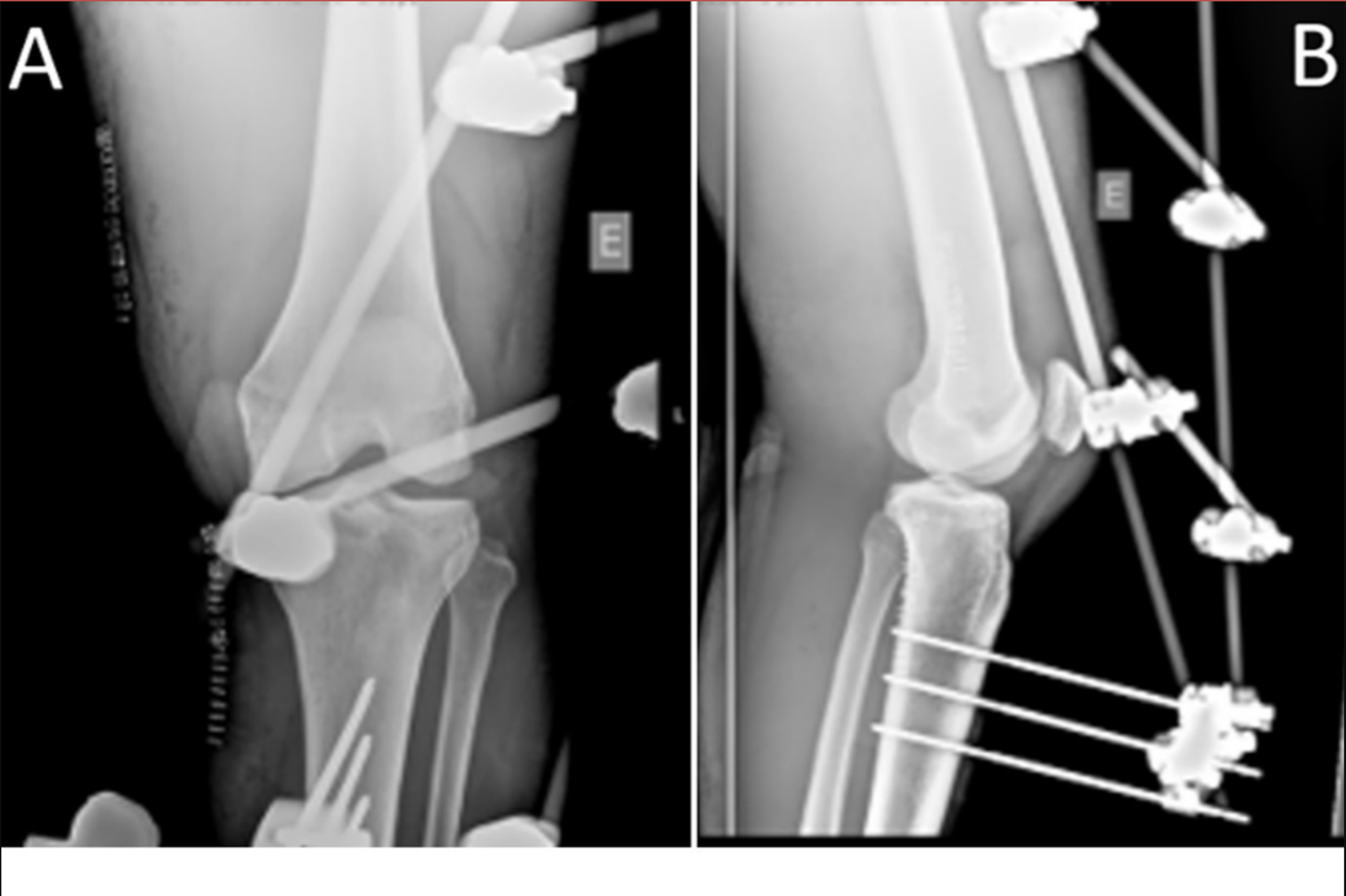 Cureus Knee Dislocation With Vascular and Nerve Injury in a