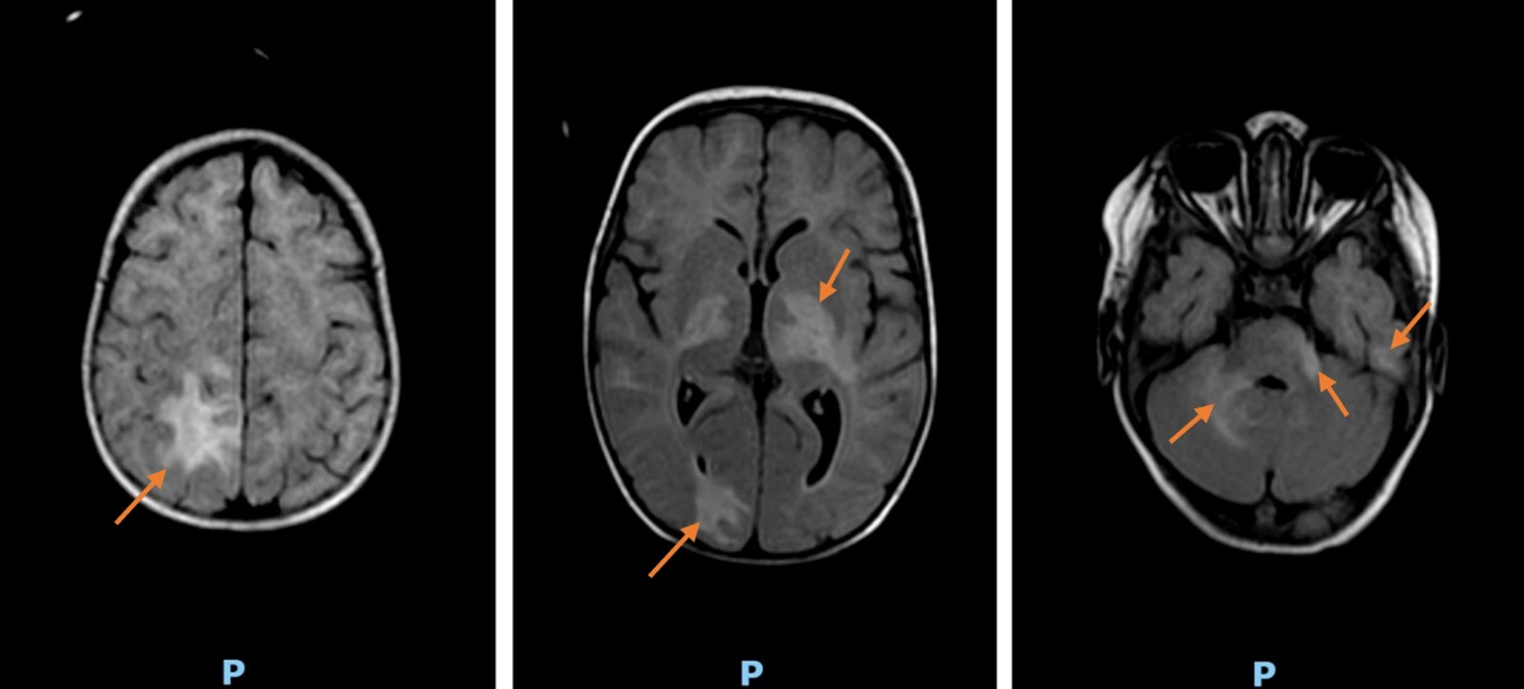 Cureus | Hemiparesis Revealing a Unique Neurological Hemophagocytic ...