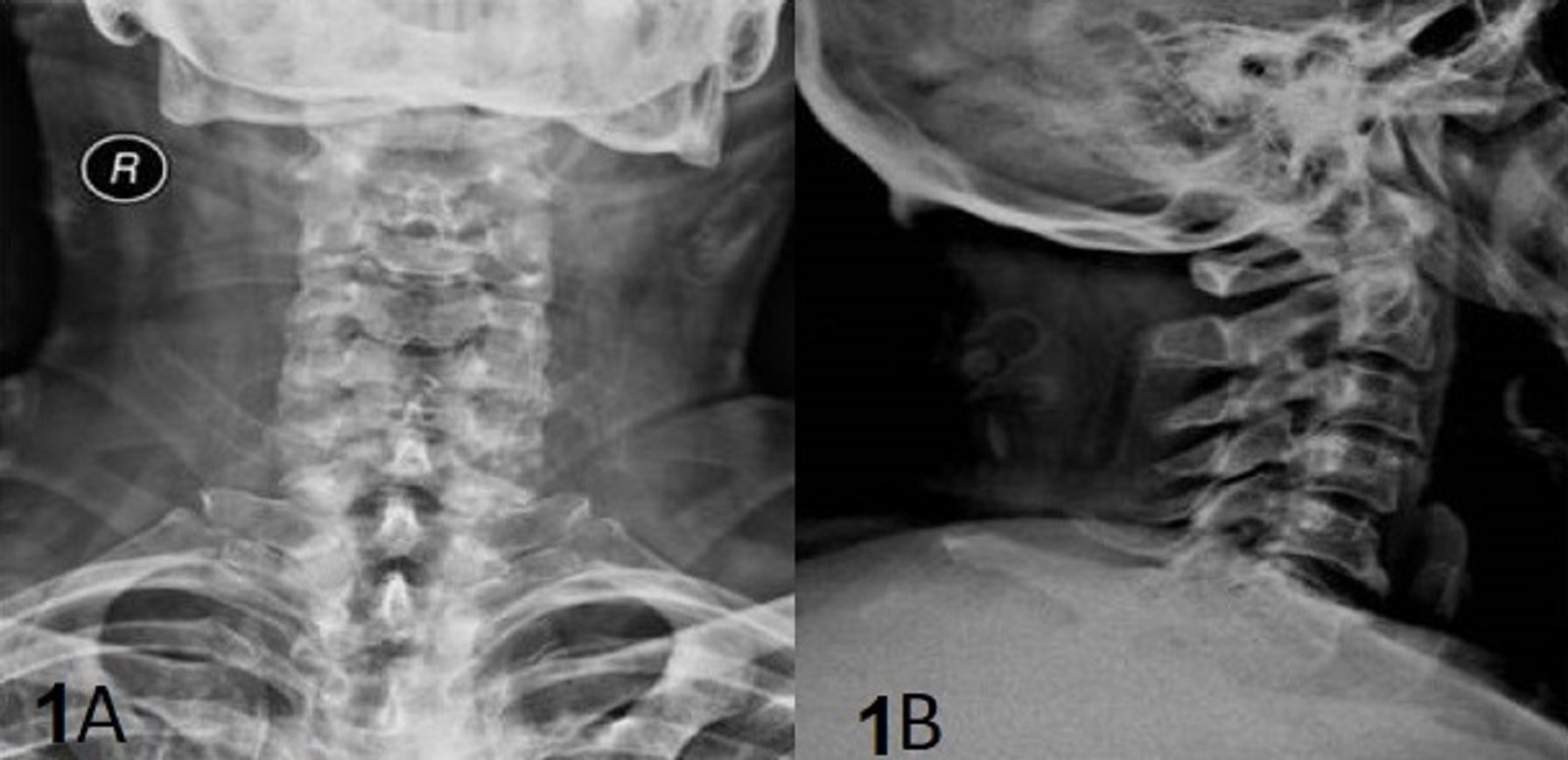 female abnormal cervical spine x ray