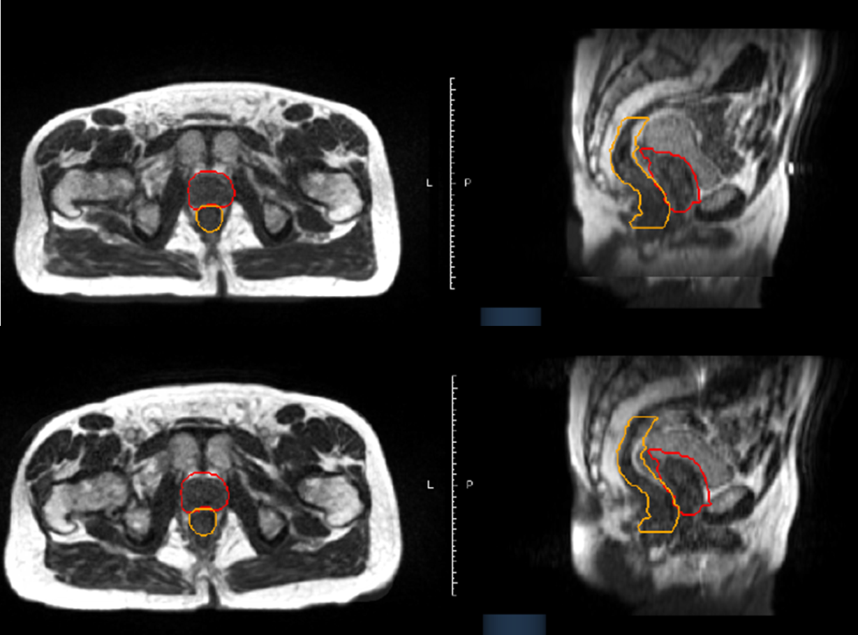 mri prep per la prostata