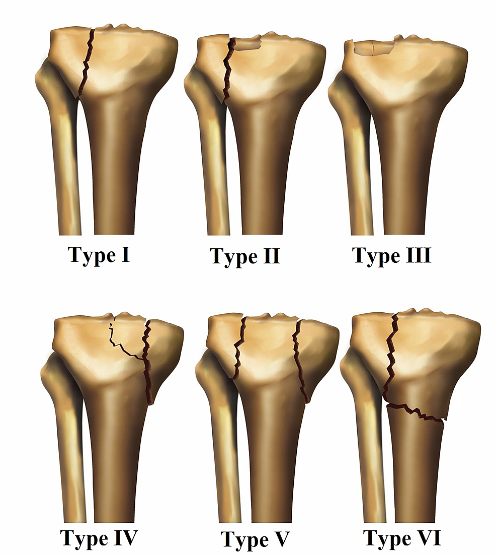 tibial condyle fracture