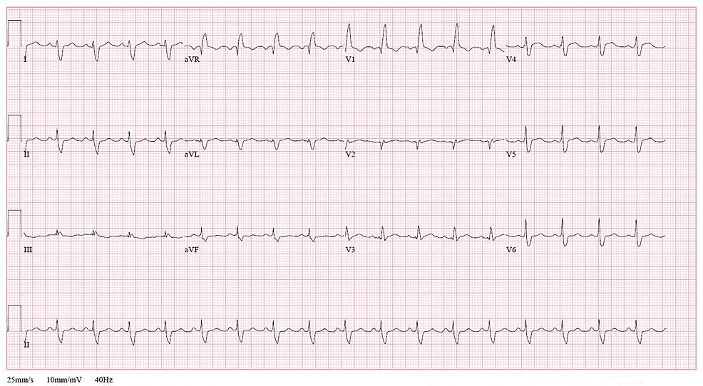 Electrocardiogram-(EKG)-on-admission-(Hospital-Day-1)-revealed-sinus-tachycardia-and-a-right-bundle-branch-block
