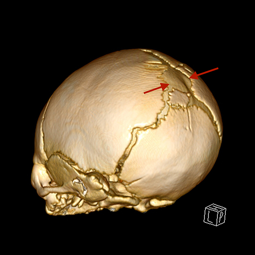 Cureus Posterior Fontanelle Encephalomeningocele in a Neonate A Case Report