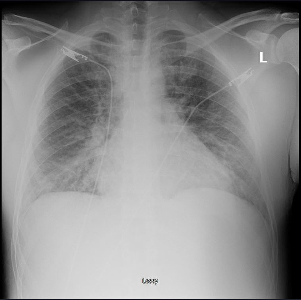 A-Chest-X-ray-on-admission-(Hospital-Day-1)-demonstrating-pulmonary-vascular-congestion