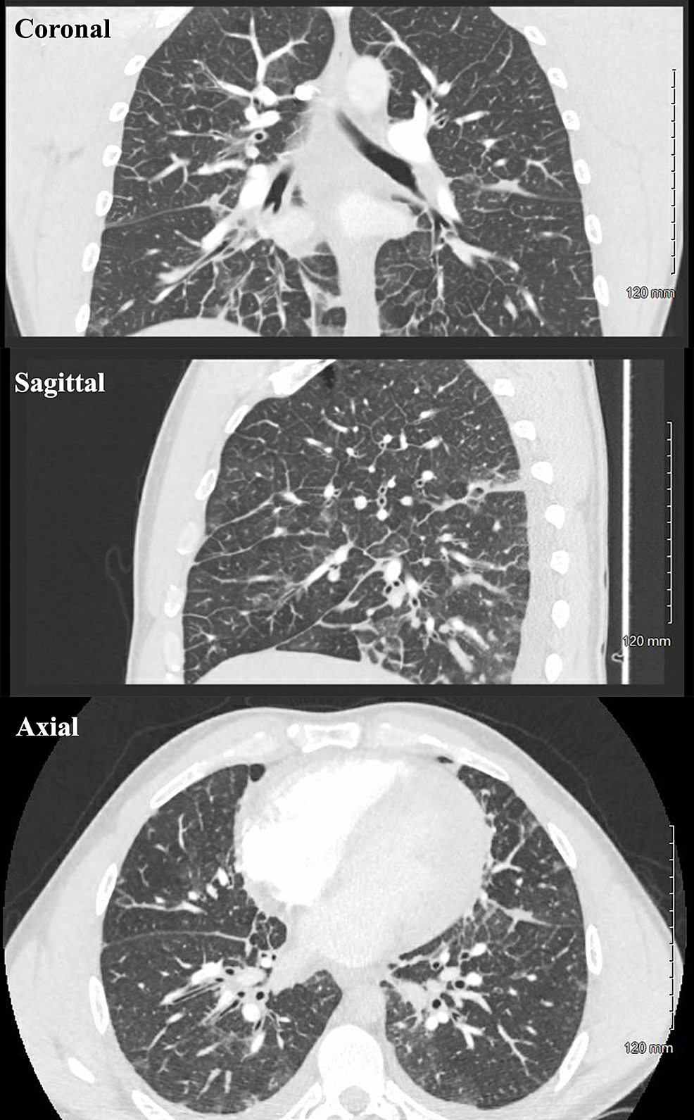 Computed-Tomography-(CT)-Angiography-on-admission-(Hospital-day-1)-revealing-interlobular-septal-thickening,-patchy-multifocal-ground-glass-opacities,-small-bilateral-pleural-effusions,-and-multiple-small-mediastinal-lymph-nodes.-