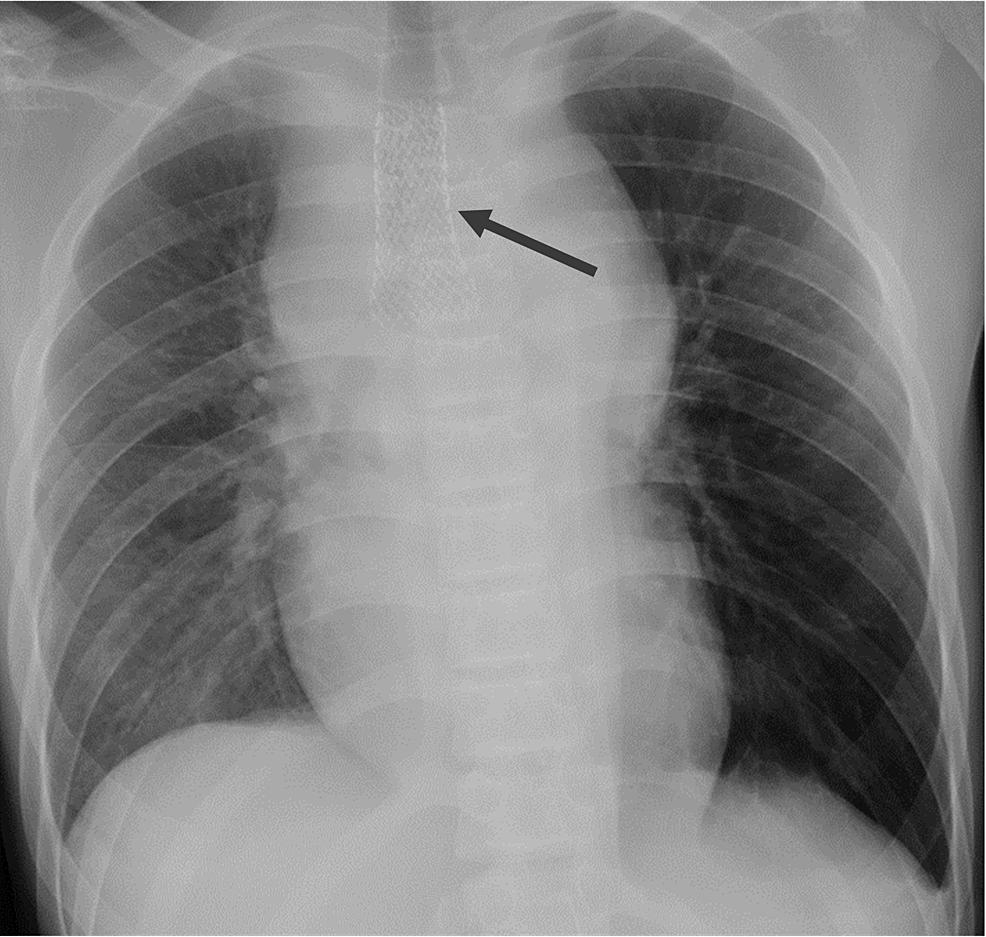 Cureus | Airway Emergencies Due to Anterior Mediastinal T-Lymphoblastic ...