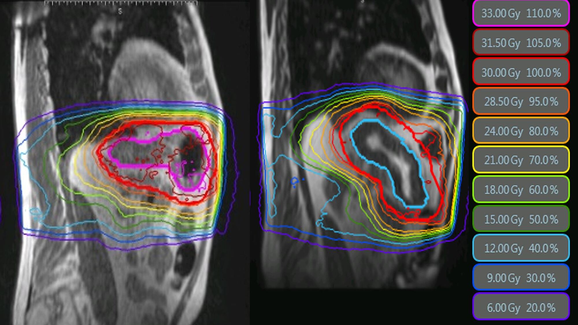 Cureus A New Era of Image Guidance with Resonanceguided Radiation Therapy for